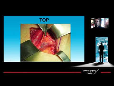 10 Intervento di TOP(Total Open Preperitoneal Technique) - Giampiero Campanelli (Milano)