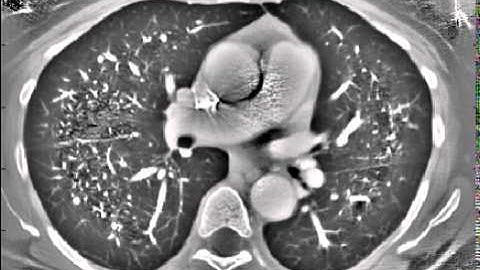 Detection of Pulmonary Nodules in Computer Tomography (FlyerScan)