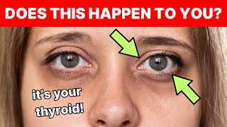 This Is How Thyroid Issues Begin and No One Tells You | Signs and Symptoms of Hypothyroidism by Natural Cures 59,547 views 13 days ago 6 minutes, 52 seconds