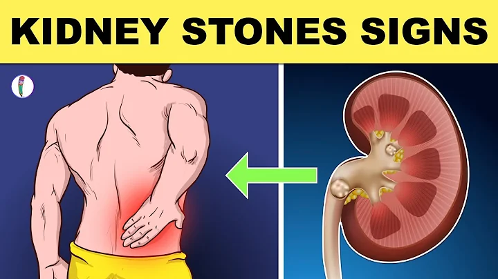 Kidney Stones Symptoms - All You Need to Know - DayDayNews