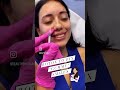 بوتوكس الابتسامة اللثوية
