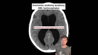 Insomniac anatomy academy 398: hydrocephaly. Hydrocephalus? #science #stem #anatomy #brain #babies