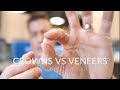 CROWNS VS VENEERS - Which is best?