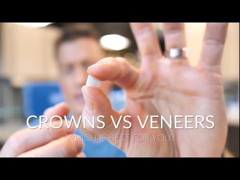 Video: Veneers Vs Crowns: Apa Pro Dan Kontra Masing-masing?