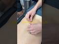 Back Spasm? Fix it with Dry Needling
