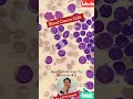 रक्त और अस्थि मज्जा कैंसर के तीन मुख्य प्रकार हैं ल्यूकेमिया, लिम्फोमा और मायलोमा।