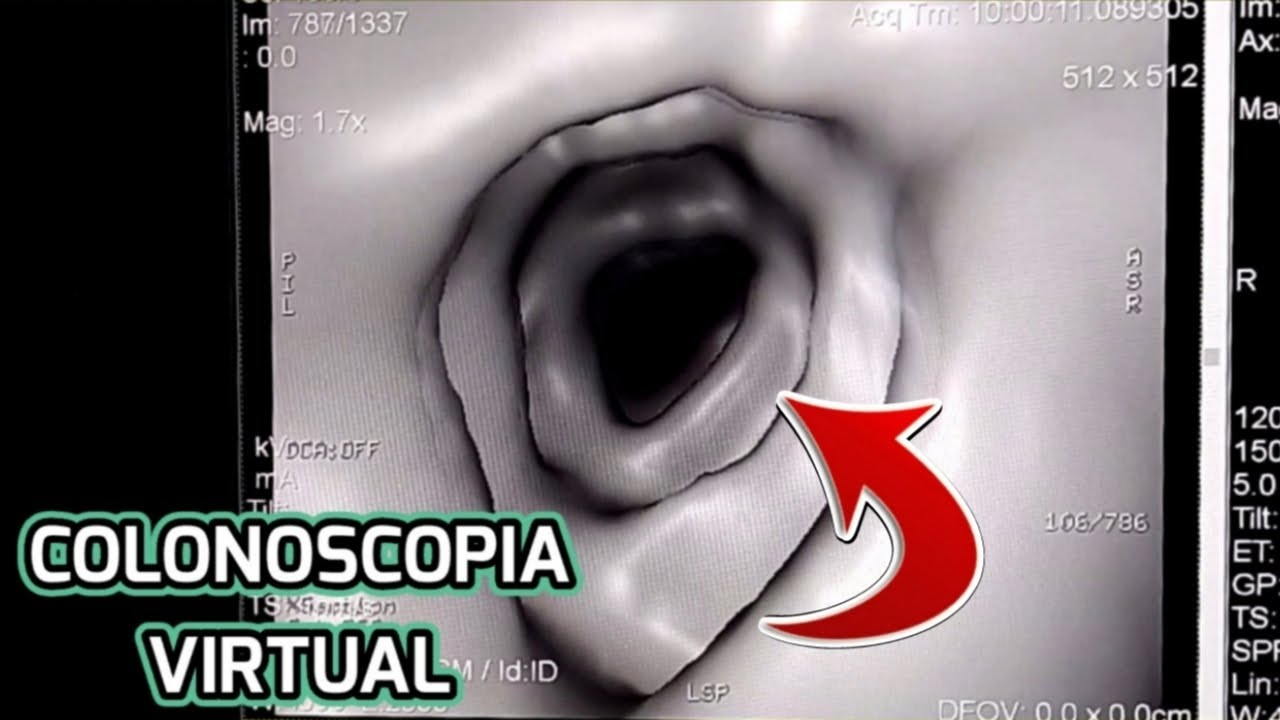EL INTERIOR DEL COLON EN UNA COLONOSCOPIA VIRTUAL ☢😲 - YouTube