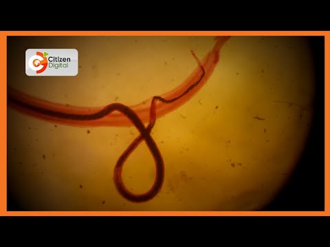 Video: Schistosoma haematobium husababisha nini?