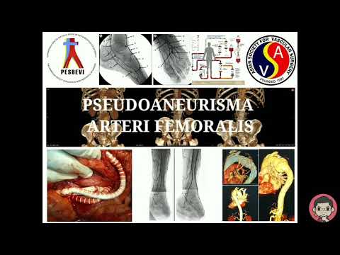 Hindari Tusukan Femoral Saat HD