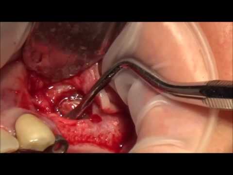 Βίντεο: Αναδιαμόρφωση - μη χειρουργική ανύψωση