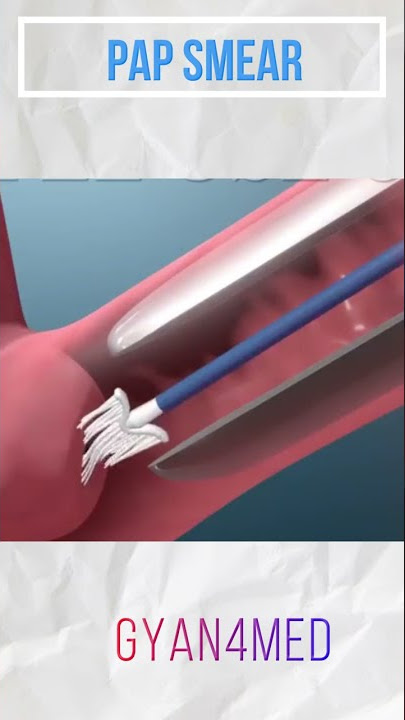 What is a pap smear?