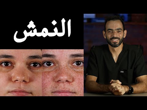النمش