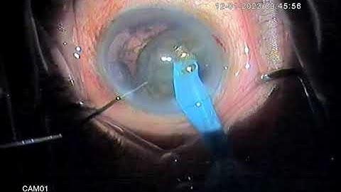 Tilt and tumble for soft #Cataract
