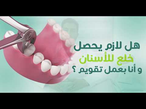 هل لازم يحصل خلع و انا بعمل تقويم اسنان د مصطفى الشيتي