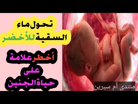 حذاري من تغير ماء الجنين السقية من ابيض الى اخضر علامة قد تجعل ولادتك صعبة