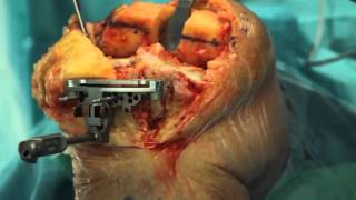 TOTAL KNEE REPLACEMENT FOR A VARUS DEFORMITY screenshot 5