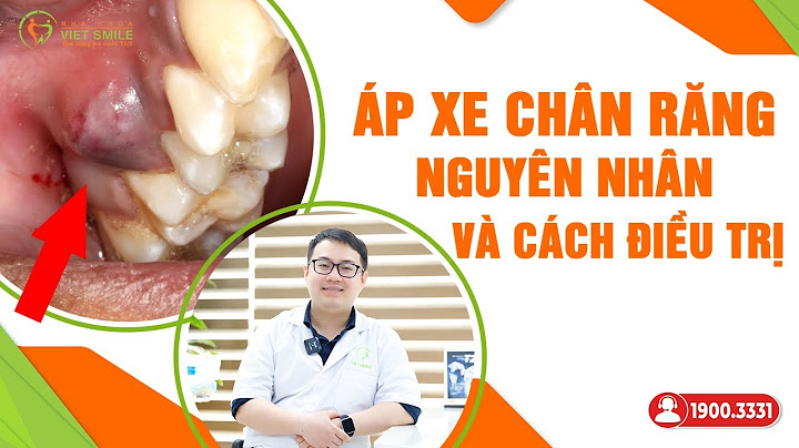 Có nên nặn mủ chân răng