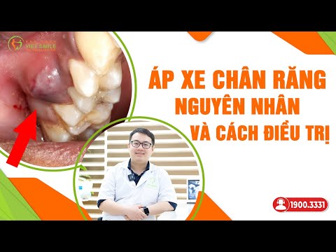 Video Áp xe chân răng là gì? Nguyên nhân và cách điều trị - youtube