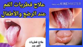 دكتارين جل | نيستاتين نقط | العلاج المناسب لفطريات الفم للرضع والأطفال |كيفية الاستخدام|Daktaren gel