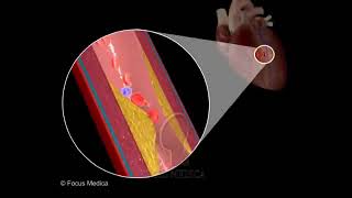 Acute coronary syndrome Acute coronary syndrome