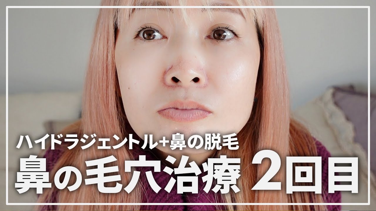 鼻の毛穴開きを治す 美容皮膚科で脱毛 角栓吸引治療2回目 40代美容 Youtube 鼻の毛穴開きを治す 美容皮膚科で脱毛 角栓吸引治療2回目 40代美容 Youtube