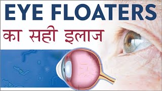 Eye Floaters Easy & correct treatment | Causes of Eye Floaters | फ्लोटर्स क्या है? और इस का सरल इलाज