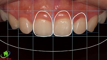 Digital Smile Design – kiến tạo nụ cười đẹp chuẩn - ÁP DỤNG vào phẫu thuật cười hở lợi