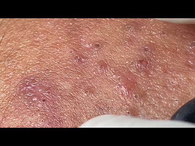 Acne Treatment Huong Da Nang#568 | 2023