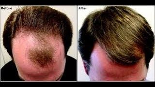 बालों का झड़ना बंद कर तेजी से नये बाल उगाने और लम्बे करने का बेहतरीन नुस्खा,hair fall treatment home
