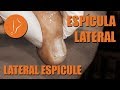 Ingrown toenail with lateral espicule - Espícula lateral [Podología Integral] #podologiaintegral