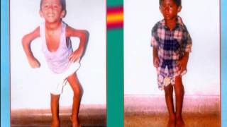 Polio Cases Video Premahospital Vizag India 0891 2526791 92 Youtube