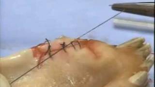 Introduction to Periodontal Surgery Techniques: Initial Incisions and Suturing