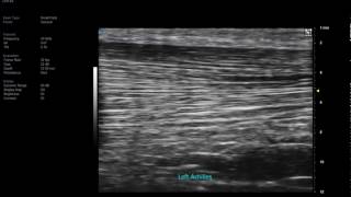 Vevo MD UHF 48 - Lt Achilles Tendon with each collagenous fibre clearly delineated