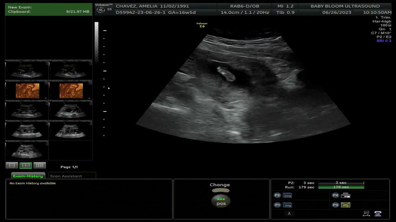 Baby bloom ultrasound live stream youtube