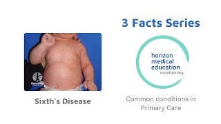 #roseola #sixthsdisease #3facts
