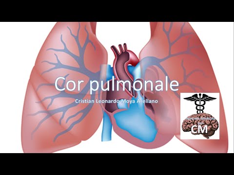 Vídeo: Cor Pulmonale Agudo Y Crónico: Síntomas, Tratamiento