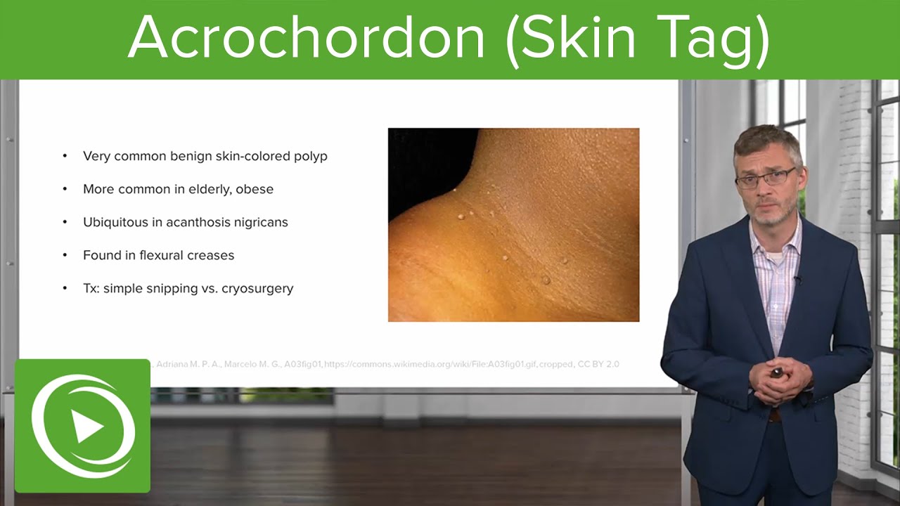 Acrochordon (Skin Tag): Dermatology