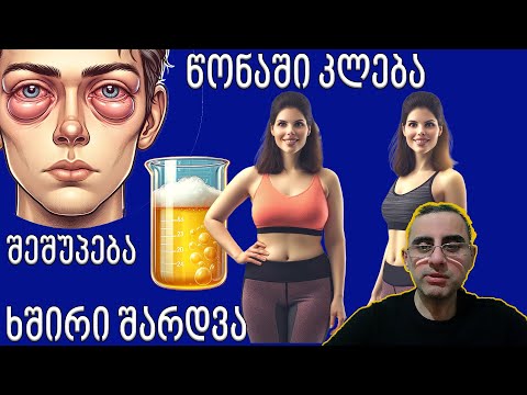 ვპასუხობ კომენტარებს 23:  ვენური უკმარისობა, ფეხების შეშუპება,  გულის ფრიალი