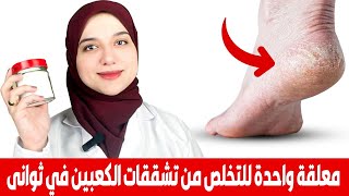 معلقة واحدة للتخلص من تشققات القدمين و جفاف كعب القدم في ثوانى ..