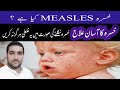 Measles causes symptoms and treatment in Urdu,Hindi/khasra ka ilaj/Measles treatment/خسرہ کا علاج