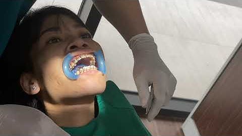 Gắn Mắc Cài Kim Loại 3M Mỹ! Dr Cường