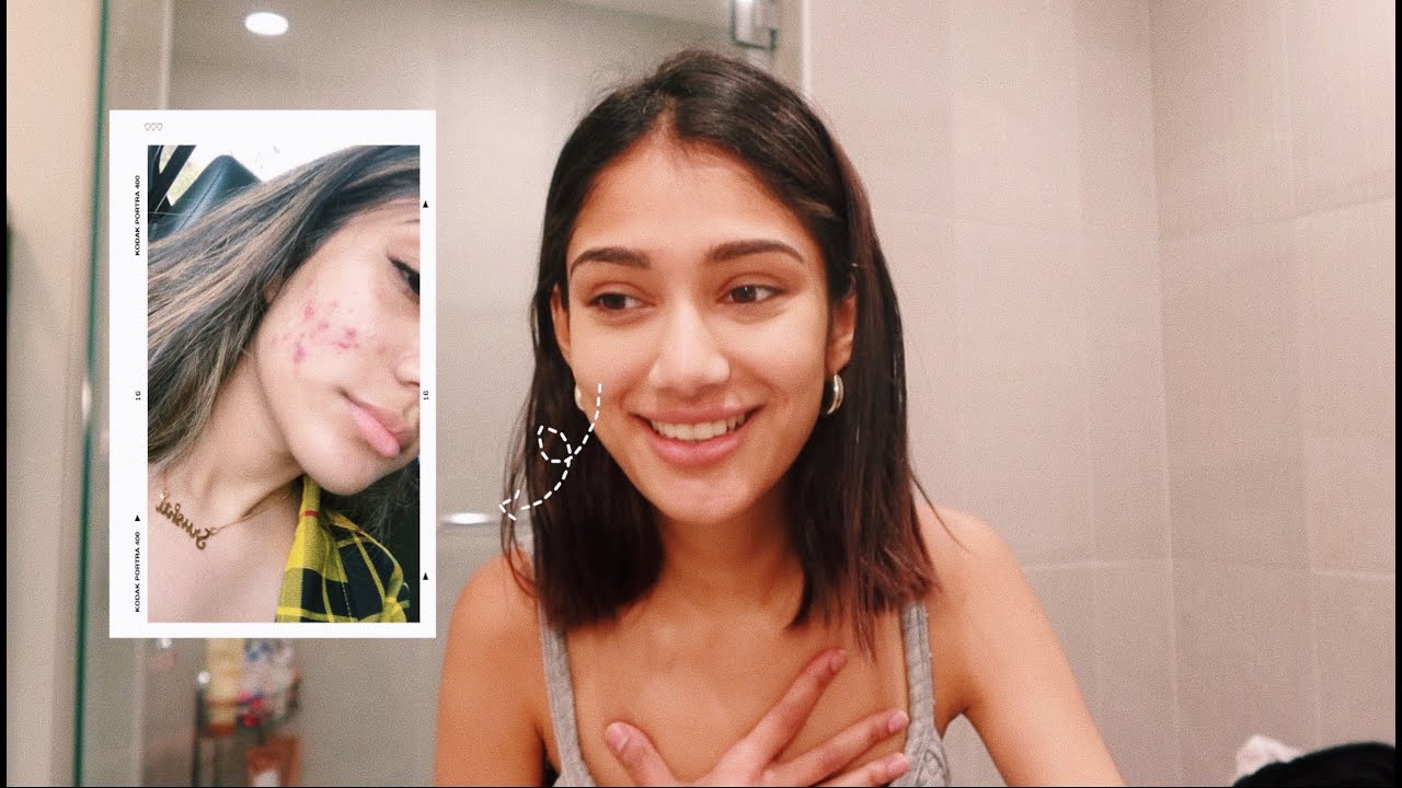HOW I CLEARED MY ACNE | MY SKIN JOURNEY - YouTube