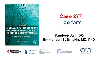 Case 277: Manual of CTO PCI - Too far?