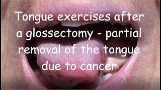 Tongue exercises after a glossectomy