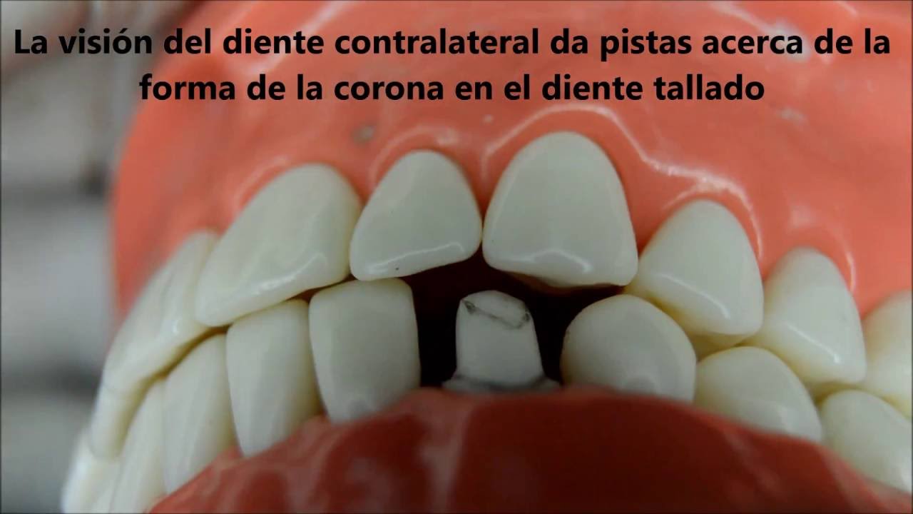 Tallado de canino inferior para núcleo fortalecido parte 2 (sin audio aún)