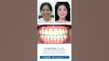 CHINH PHỤC NỤ CƯỜI ĐẸP TẠI NHA KHOA BÁC SĨ MIÊN ĐẮK LẮK