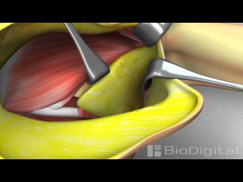 3D Medical Animation of a Mastectomy