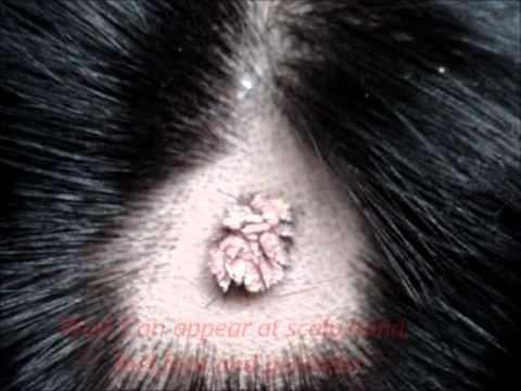 wart on scalp