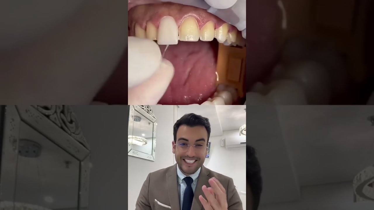DENTISTA mostra como se coloca FACETA NOS DENTES