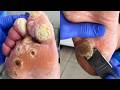 😲My Feet Have Developed Many Warts, Requiring Multiple Applications Of Medication And Trimming